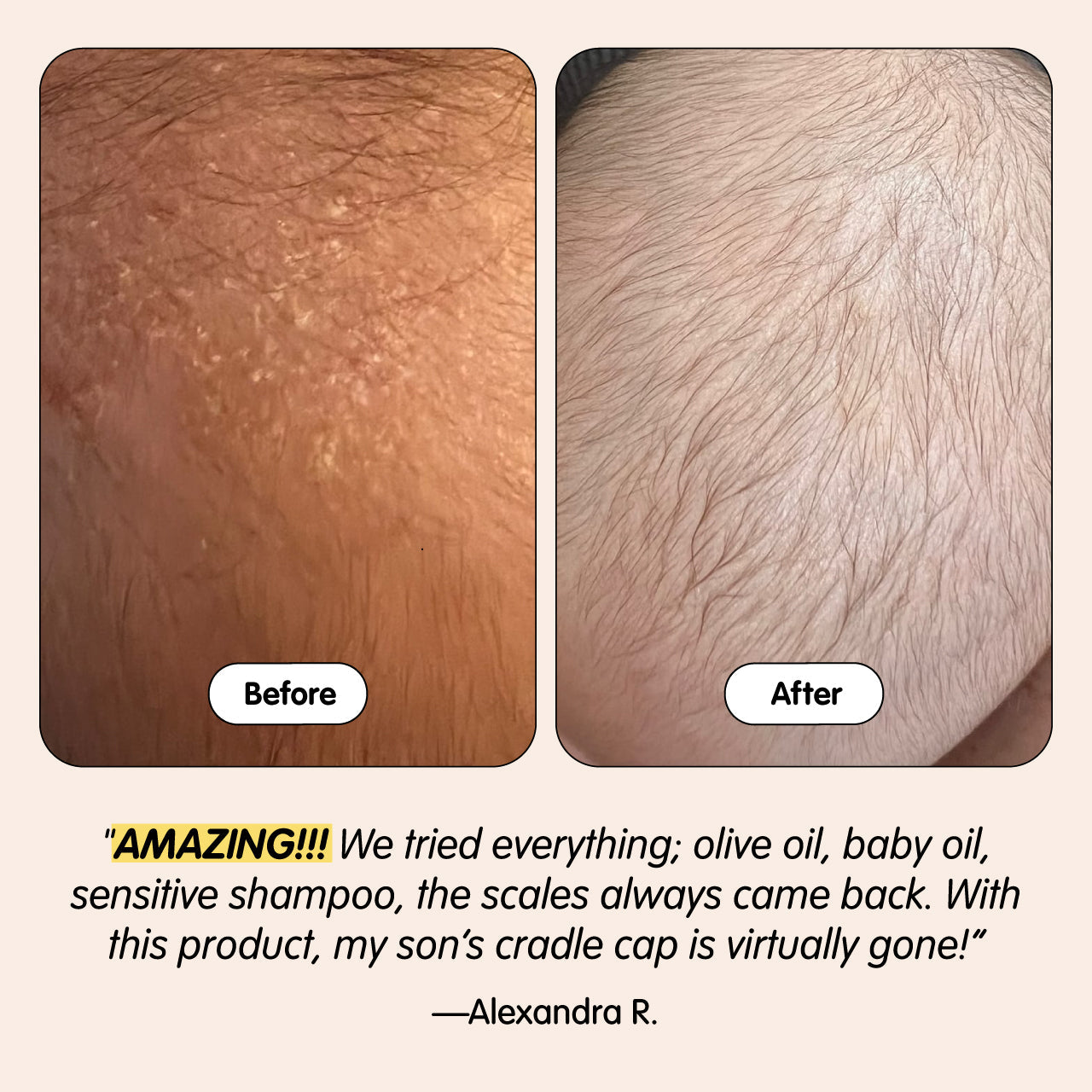 Bye-Bye Cradle Cap