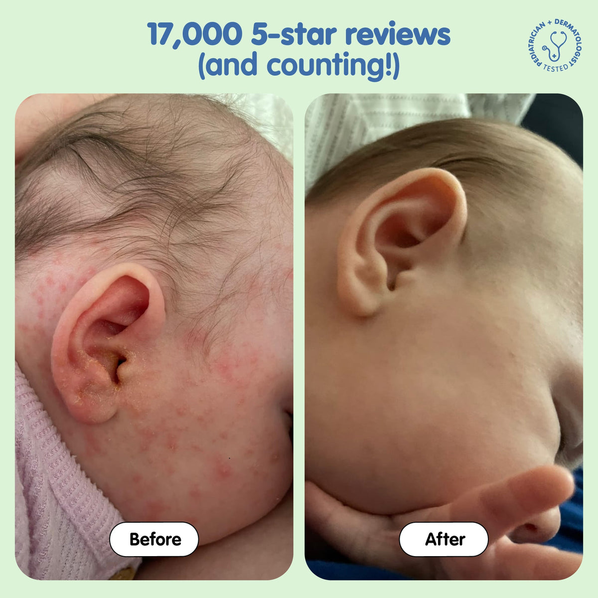 All Over Ointment Eczema Treatment